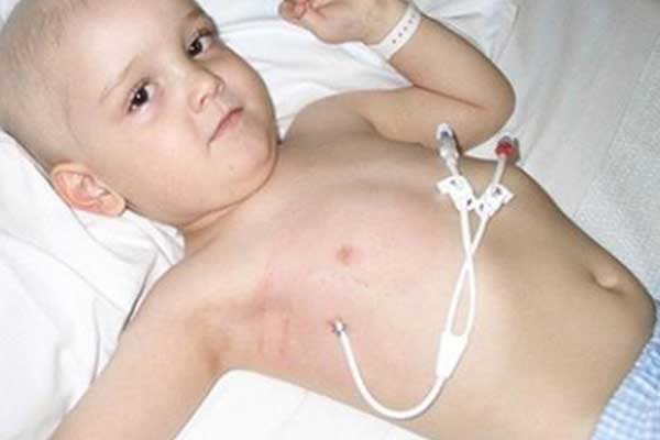اعراض سرطان الكبد عند الاطفال