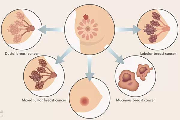 الكشف المبكر عن سرطان الثدي بالصور