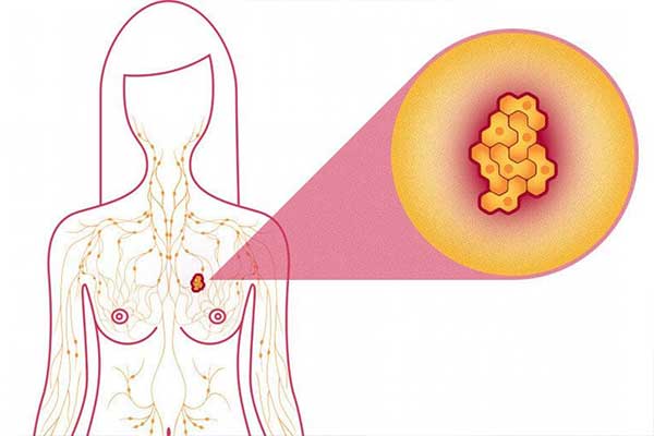 الكشف المبكر عن سرطان الثدي بالصور