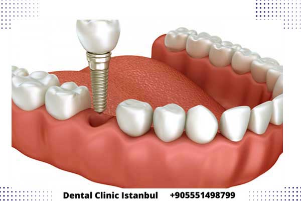 أنواع زراعة الأسنان في تركيا - خيارات متنوعة وجودة عالية