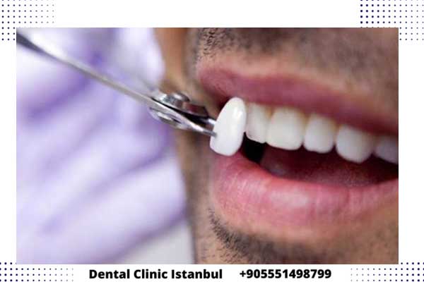 تقنيات علاج الاسنان في تركيا - دليلك لإختيار العلاج المناسب لك
