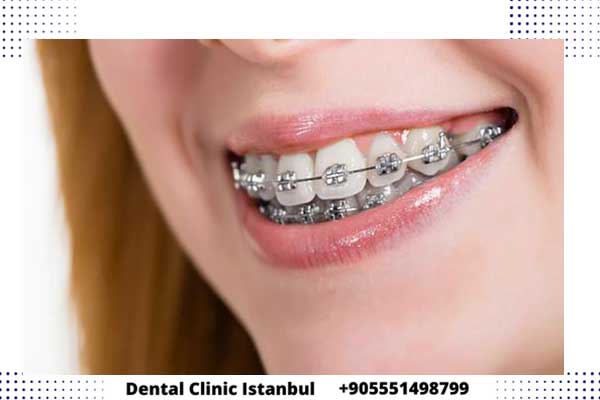 تقويم الاسنان في تركيا