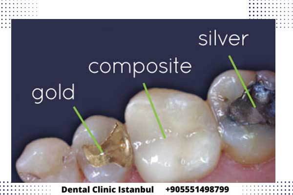 حشو الأسنان في تركيا - أنواع ومميزات وعيوب كل حشوة