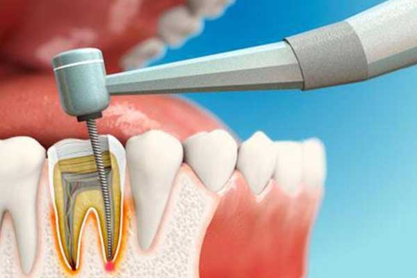 تكلفة علاج عصب الأسنان