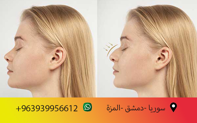 تجميل الانف في سوريا: دليلك الشامل 2025