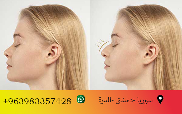 تكلفة عملية تجميل الأنف في سوريا 2025
